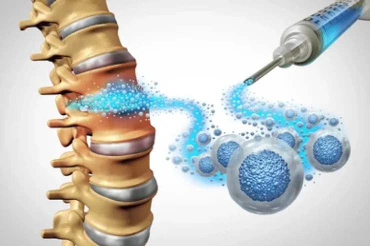 Stem Cell Therapy